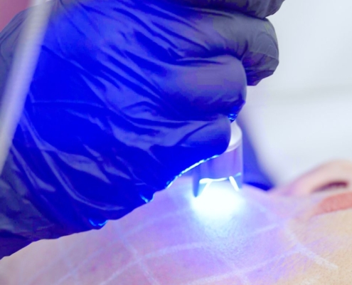 tratamiento con k-laser en madrid